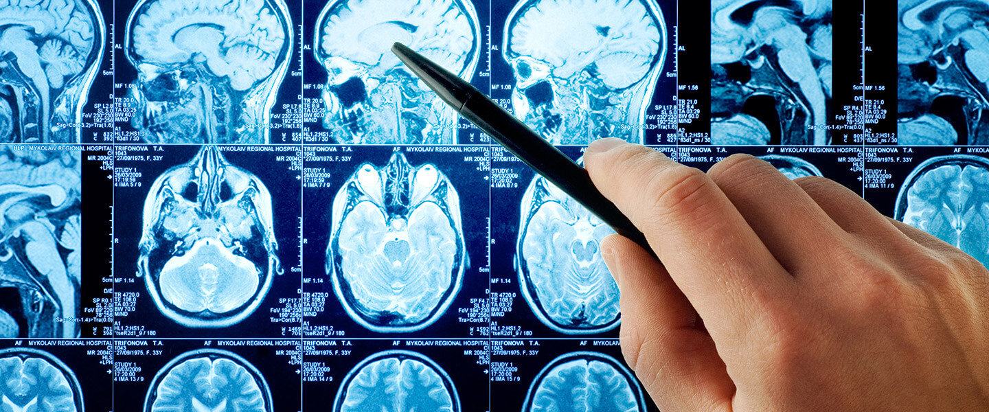 Unique Neural Activation Pattern in People With Co-Occurring Bipolar Disorder and Alcohol Use Disorder Points to Future Treatment Targets
