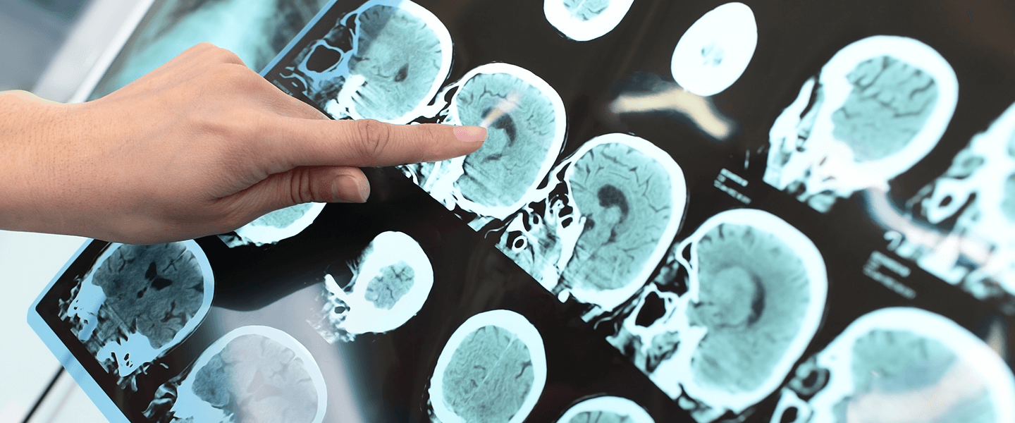 Testing a New Way to Precisely Target and Predict the Impact of TMS Brain Stimulation for Depression
