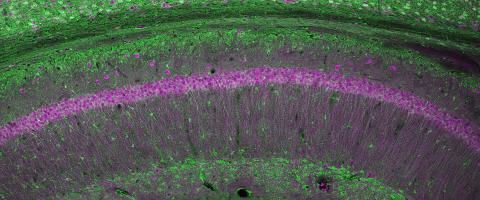 Variations in Schizophrenia-Linked Gene Are Linked With Pathology in Prefrontal Cortex, Impairing Cognition